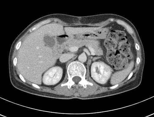 Axial CT scan reveals marked gastric wall thickening, (B) Small bowel T-cell lymphoma.