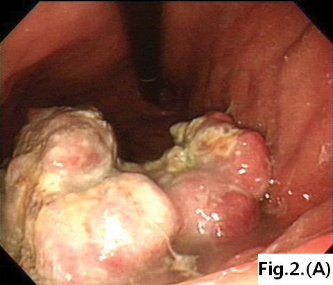 dilatation. GI, gastrointestinal. Fig. 2. Endoscopic findings of primary gastrointestinal T-cell lymphoma.