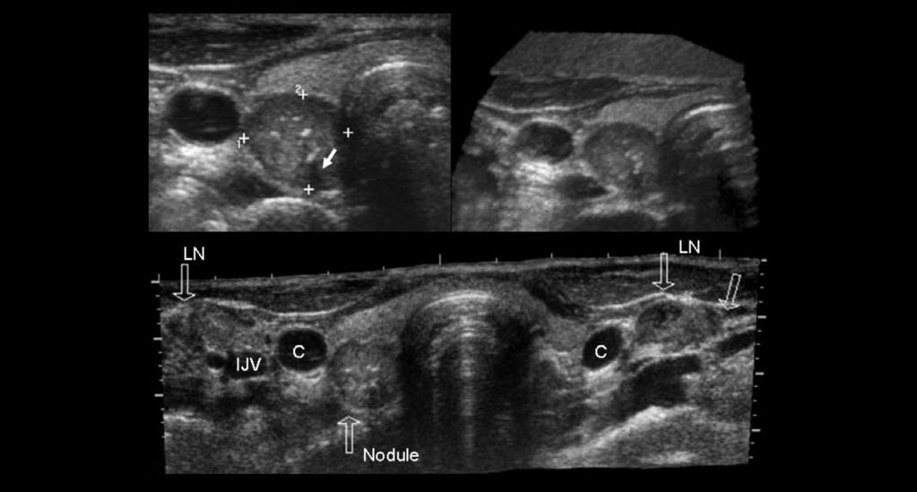 () hypoechoic nodule containing multiple internal