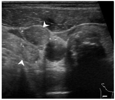 Examples of suspicious lymphadenopathies