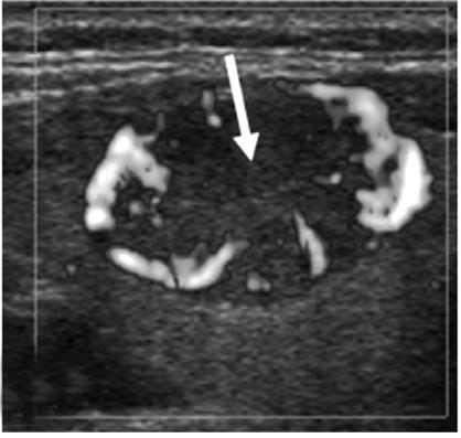 Diagnostic pproaches to Thyroid Nodules C D Figure 9.