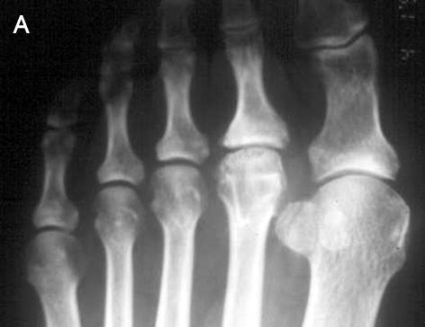 incongruent articular surface, but revealed increase of joint space without further deformity and