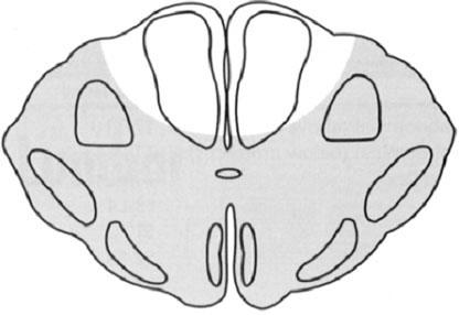 전방척수증후군 (anterior cord syndrome) 은운동기능과심부통증및온도감각의완전한소실을나타내지만, 후주 (dorsal column) 는보존되기때문에가벼운촉각, 위치및진동감각은남아있게된다. 기능적회복은매우불량하 여약 10% 의환자에서만의미있는기능회복을기대할수있다.