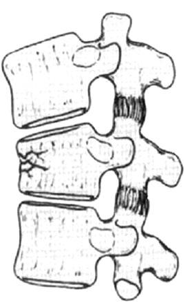 다른약물치료제로는 monosialotetrahexosyl ganglioside (GM1), thyrotropin-releasing hormone