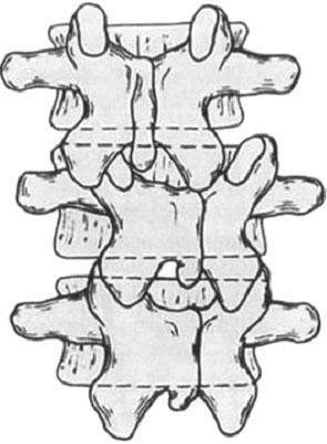 These fractures may involve both endplates (A, type A), the superior endplate only