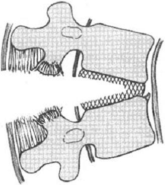 through the bone (C), or at two levels with the middle column injured
