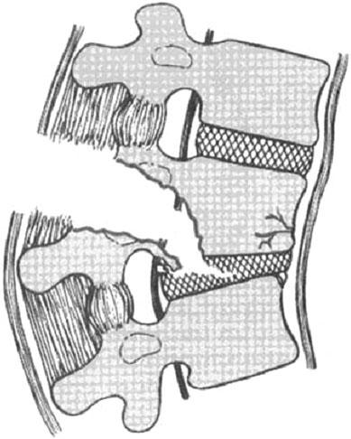Denis classification of fracture-dislocations.