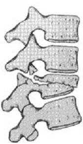 through the bone or at two levels with the middle column injuried through