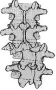 이것에의하면해부학적인척추는 3 부위로나뉘는데, 전주 (anterior column) 는전방종인대, 추체와추간판의전방 1/2 이포함되며,