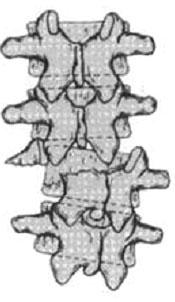 fracture), Chance 골절, 굴곡 - 신연손상 (flexion- distraction injury), 전이성골절