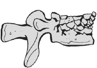 may be appropriately treated with shortsegment posterior instrumentation constructs by