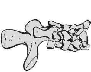 전방위 (circumferential) 도달법이필요한흉추골절도있는데, 척추강의침범이있고심한불안정성을동반한 3 주 (column)