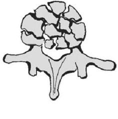 압박골절 (compression fracture) 설상압박골절에서후만변형이 20 30 도이상이거나, 전방추체높이의감소가 50% 이상일때수술적치료의대상이된다.