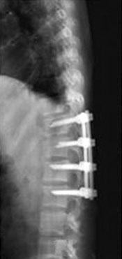 The preoperative MRI (C), and CT (D) showed the cord compressed