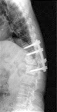 numbness on her both lower extremities with thoracolumbar