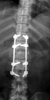 The patient complained paraparesis at both