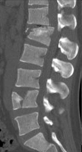 The preoperative x-ray shows kyphosis at