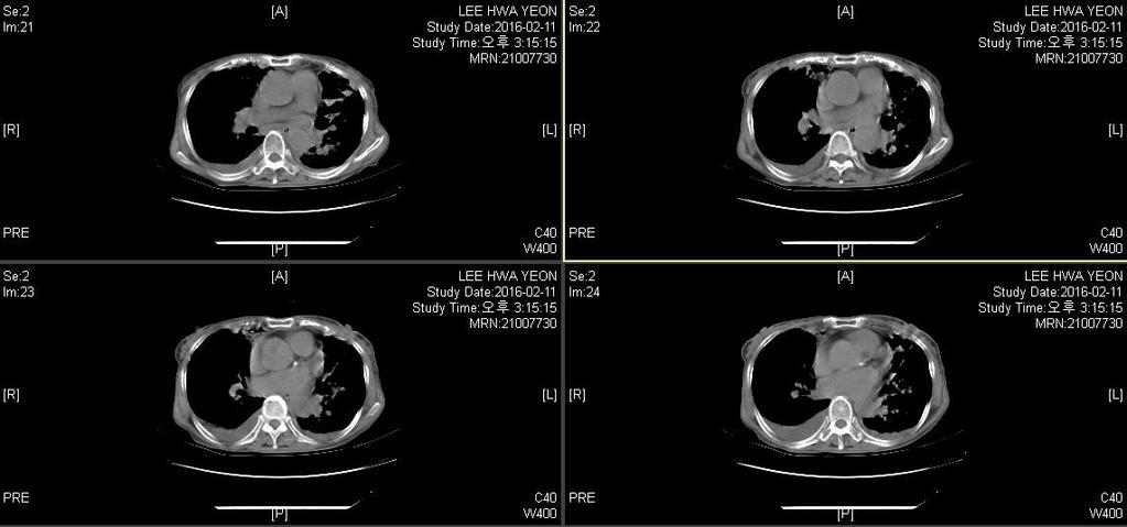 JW Lee et al. 167 Figure 2. The chest computed tomography(ct) on Febraury 11th 2016.