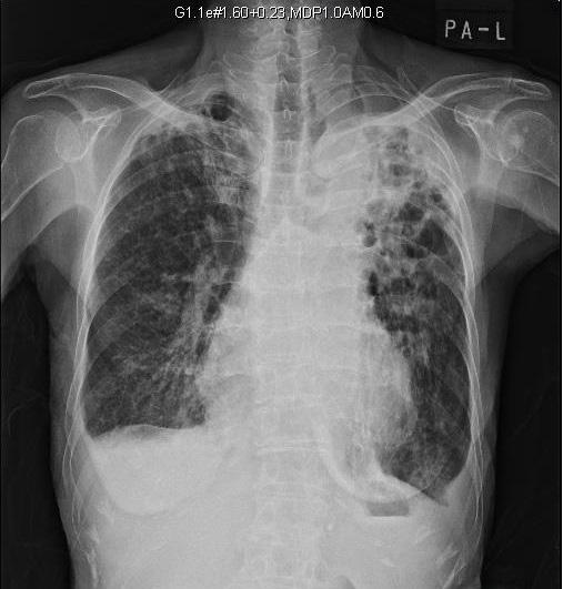 170 Case Report of a Soyangin Patient with Aftereffects of the Tuberculosis 339.4mg 140 2C#2 로체중을측정하여 F/U 하였다.