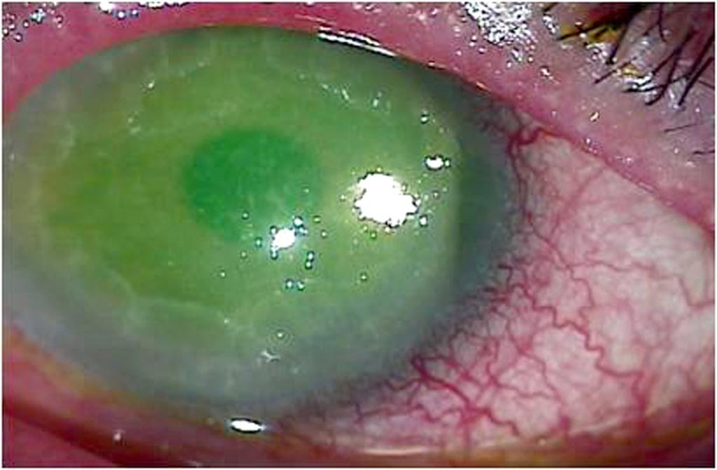 (E) Three months after amniotic membrane transplantation, geographic epithelial ulceration appeared.