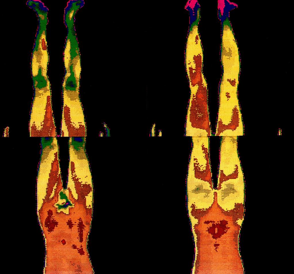 다발성 요추간반 탈출증에서의 컴퓨터 적외선 전신 체열 촬영의 진단적 가치 Fig. 3. Postoperative D1T1. After chemonucleolysis on L2/3 only, the severe hypothermic was markedly improved on right anterior thigh.