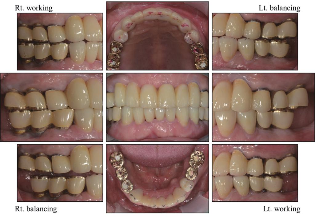 was placed and adjusted to achieve group function (Fig. 16). One week later, a maxillary occlusal splint was placed and the patient was instructed to wear the occlusal splint at night.