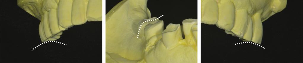 fter removal of the existing implant prosthesis, a preliminary impression was taken to create a provisional restoration.