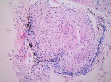 - 이병후외 6 인 : 간의유육종증 1 예 - Figure 1. Transbronchial lung biopsy (TBLB) specimen of lung shows a non-caseating granuloma with multinucleated giant cells (H & E stain, 200) Figure 2.