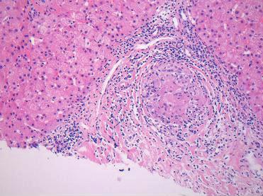- 대한내과학회지 : 제 74 권부록 1 호 2008 - Figure 4. Biopsy specimen of the liver shows well-defined, non-caseating epithelioid cell granuloma in the portal tract (H & E stain, 200).
