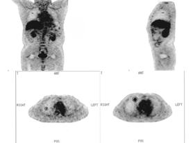 - 문희선외 6 인 : 간내원발병소없는폐전이간세포암종 - Figure 7. PET after 1 year. The known pulmonary nodule in the RUL shows an increased FDG uptake and this is consistent with malignancy.