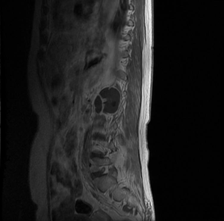 MRI showed L1, L2 vertebral body spondylitis with both paraspinal abscess formation with left hydronephrosis