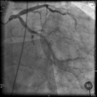 - 대한내과학회지 : 제 87 권제 5 호통권제 651 호 2014 - A B C Figure 2. Coronary angiography.