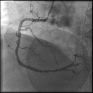 TIMI, thrombolysis in myocardial infarction. A B Figure 3. Coronary angiography.
