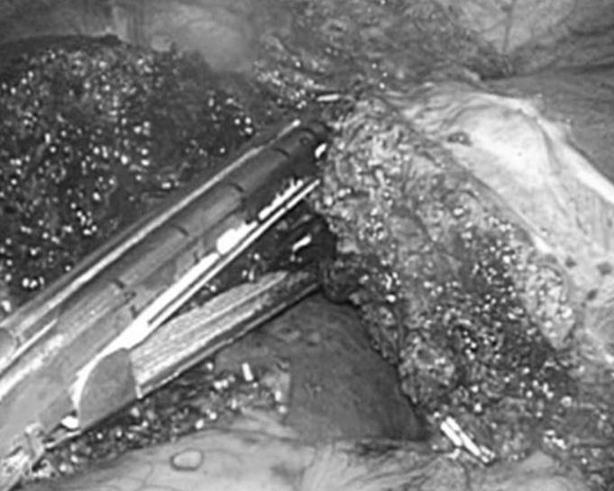 Dividing the left hepatic vein from the inferior vena cava was managed with a roticulating 45-mm endoscopic vascular GIA stapler (Covidien, Mansfield, MA, USA) during single-port laparoscopic left