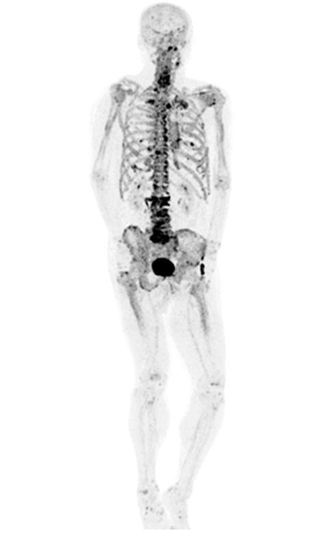 2A) 다발성척추및골반골에서골수괴사에합당한양전자결손소견 (photon defect) 이관찰되었다 (Fig. 2B). 음낭원발병변부위의조직염색상 Paget 병에합당한상피세포내 Paget 세포를관찰할수있었다 (Fig. 4A, 4B). 우측서혜부림프절부위의조직검사상 Paget 세포는진피로침범소견을보였고 (Fig.