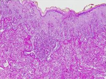 Large pale to eosinophilic intraepidermal Paget s