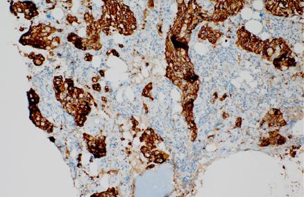 86 대한비뇨기종양학술지 제 14 권 제 2 호 2016 Fig. 4. Bone marrow aspiration, Wright-Giemsa stain x400 (A), x1000 (B).