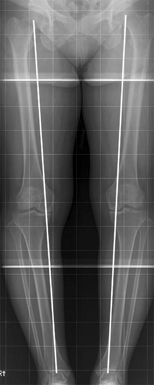대한류마티스학회지제 14 권제 3 호 2007 Fig. 1. Standing anteroposterior radiograph in extension (A) and standing 45 o flexion posteroanterior radiograph (B) of a 69-year-old female who suffered from left knee pain.