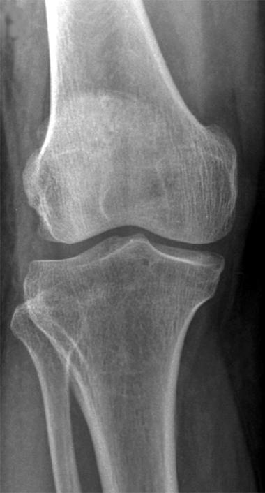 권세광ㆍ장종범 : Differential Diagnosis of Knee Pain Fig. 4. Standing anteroposterior radiographs of a 62-year-old female who suffered from right knee pain.