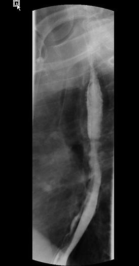 - 김병희외 6 인 : 내시경으로치료한자발성점막내식도박리증 1 예 - 증례 Figure 1. Esophagographic findings showing the double-barreled appearance of the lumen of the esophagus caused by intramural dissection.