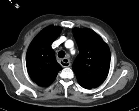 - 대한내과학회지 : 제 73 권부록 3 호 2007 - Figure 3. Chest CT scan findings demonstrate diffuse esophageal wall thickening with no air collection and a mucosal septum between the true and false lumens. Figure 4.