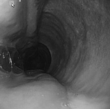 Endoscopic findings 10 days later revealed an almost normal esophageal lumen, except for the two longitudinal mucosal fold-like elevations along the previous endoscopic incision sites.