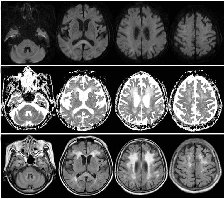 Metronidazole-Induced Encephalopathy Cho J, et al. A B C Figure 1. Initial brain magnetic resonance image.