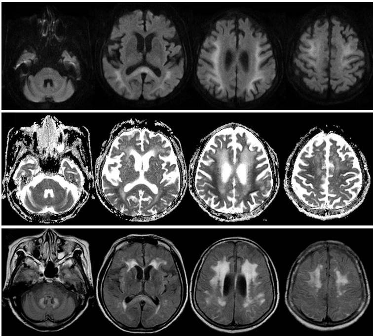 J Neurocrit Care 2016;9(1):16-20 A B C Figure 2. Follow-up brain magnetic resonance image.