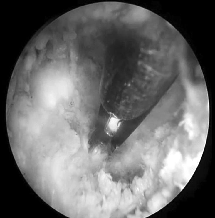 223 Biportal Percutaneous Endoscopic Spinal Surgery for Lumbar Spinal Stenosis 이용하여내시경삽입구와기구삽입구가각각다른피부절개를 통해후궁에접근하게되어내시경과수술기구들이서로충돌 하지않게되어기술적인어려움을해결하였으며, 한쪽삽입구 를통해신경조직을젖혀다른삽입구를통해쉽고안전하게조 작을할수있다.