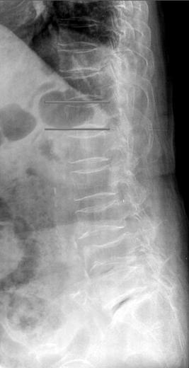 07, and that was improved to a VAS of 2.43 after vertebroplasty. VAS: Visual analogue scale, Preop.: Pre-operative, Postop.: Post-operative, F/U: Follow-up. 과 부터수일내에시행하였고증상발현으로부터자기공명영상촬영까지시간은평균 14.