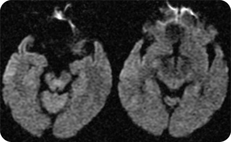 Jihyun Lee, et al.: A Case of Recurrent Transient Global Amnesia 왜왔냐? 고물었다. 또한환자자신이왜이곳에있고, 이곳이어디인지, 이곳에서무엇을했는지를주변사람들에게물었고설명해주어도계속같은질문을반복하였다.