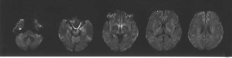 신경학적검사상특이이상소견은관찰되지않았고실험실검사에서도이상소견은관찰되지않았다. 확산강조영상 (Diffusion image) 을포함한뇌핵자기공명영상 (Brain MRI) 에서도이상소견은없었다 (Fig. 1). 기억장애가발생한지 2시간만에서울신경심리검사 (SNSB) 를실시하였다 [11]. 검사시환자는아주긴장한모습이었다.