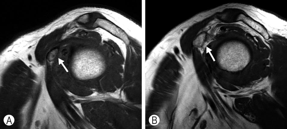 Joint capsule thickness measurement on T2-weighted fat-suppressed oblique coronal imaging.