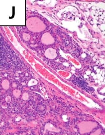 Fibrous septa surrounding follicles are more prominent.